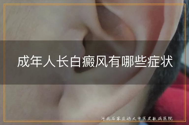 成年人长白癜风有哪些症状