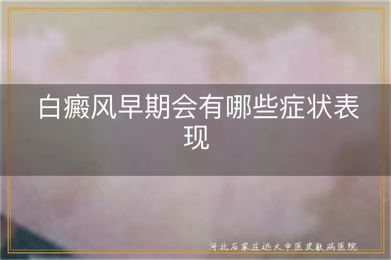 白癜风早期会有哪些症状表现,白斑初期症状表现有哪些,白癜风早期症状怎么发现