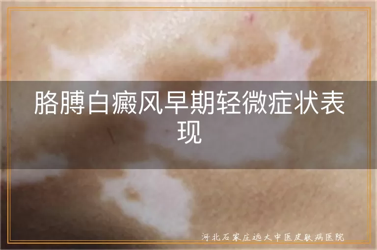 胳膊白癜风早期症状什么样,手臂白斑初期轻微表现,胳膊上白癜风轻症图片特征