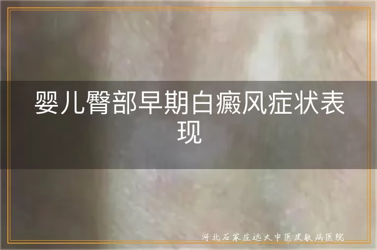 婴儿臀部早期白癜风症状表现