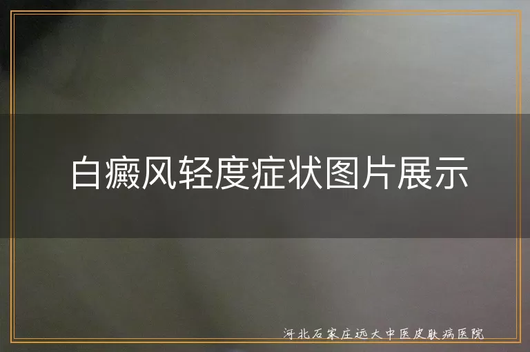 早期白癜风皮肤症状图片,白斑初期症状照片特征,轻度白癜风白斑图片表现