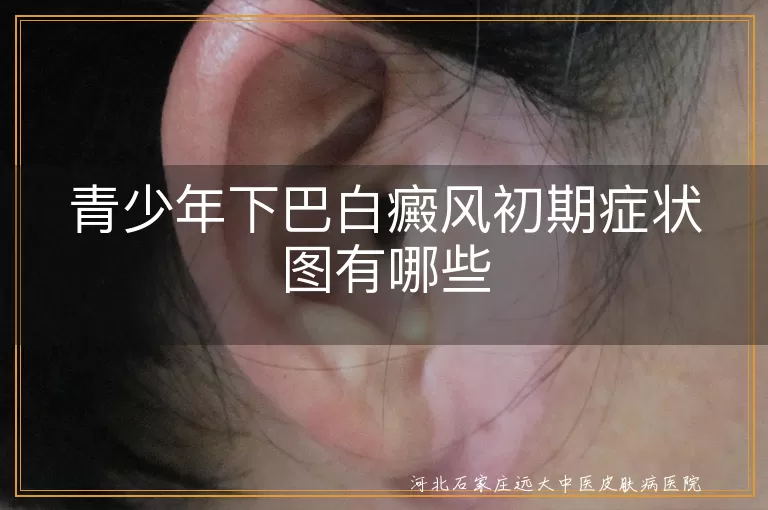 青少年下巴白癜风早期症状图,下巴白斑初期症状有哪些,青少年面部白癜风初期表现