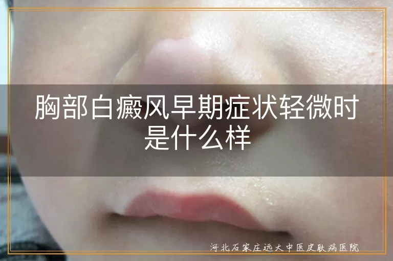 胸部白癜风初期症状什么样,胸口白斑早期表现症状,胸部白点点轻微时啥样