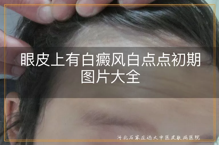 眼皮上有白癜风白点点初期图片大全