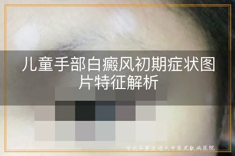 儿童手部白癜风初期症状图片特征解析