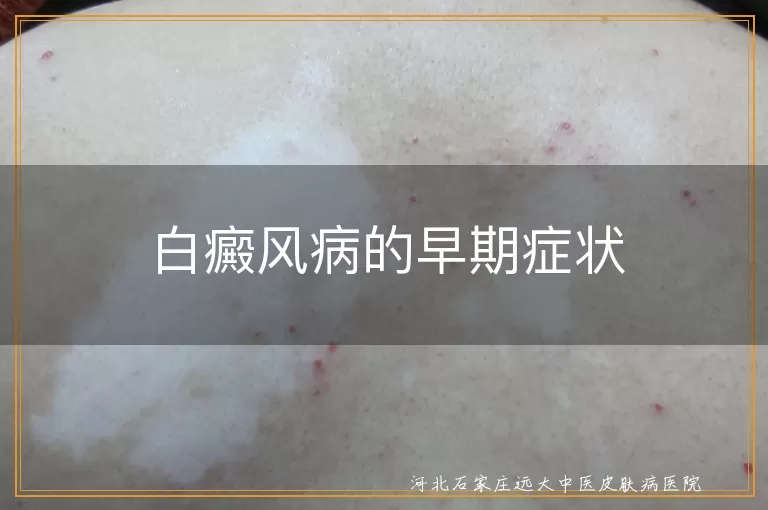白癜风病的早期症状