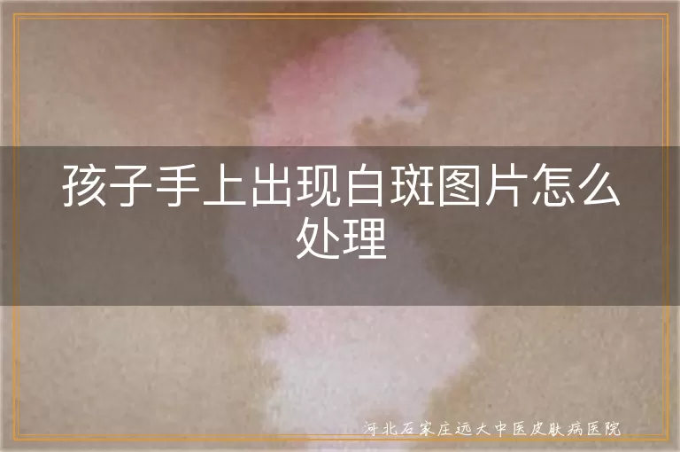 孩子手上出现白斑图片怎么处理