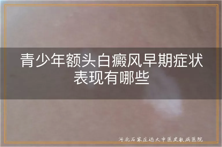 青少年额头白癜风早期症状表现有哪些