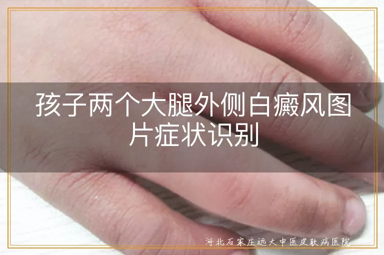 孩子两个大腿外侧白癜风图片症状识别