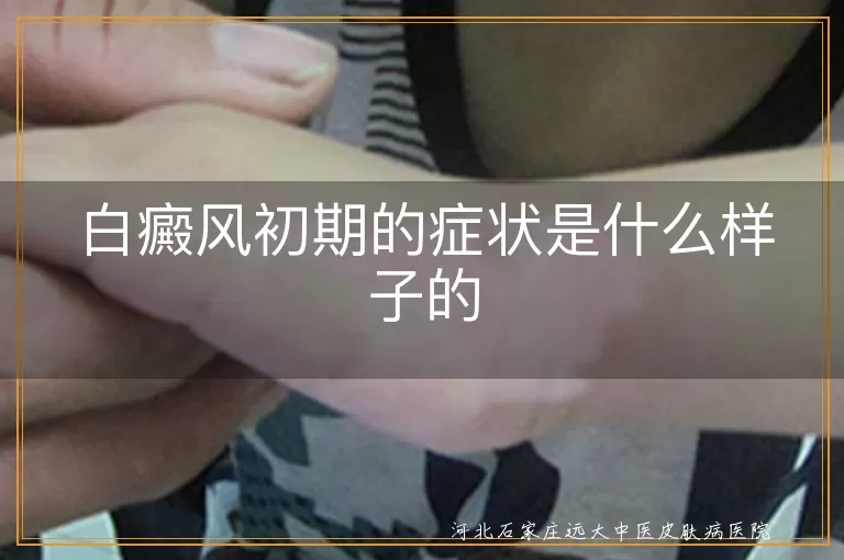 白癜风早期会有哪些症状表现,白斑初期症状是什么样子的,白癜风刚开始出现啥症状