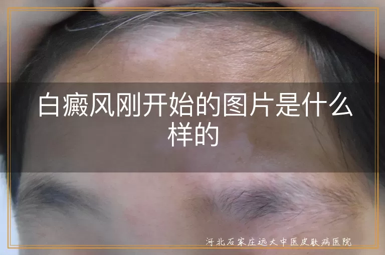 白癜风刚开始的图片特征,早期白斑症状图片展示,白癜风初期皮肤变化图