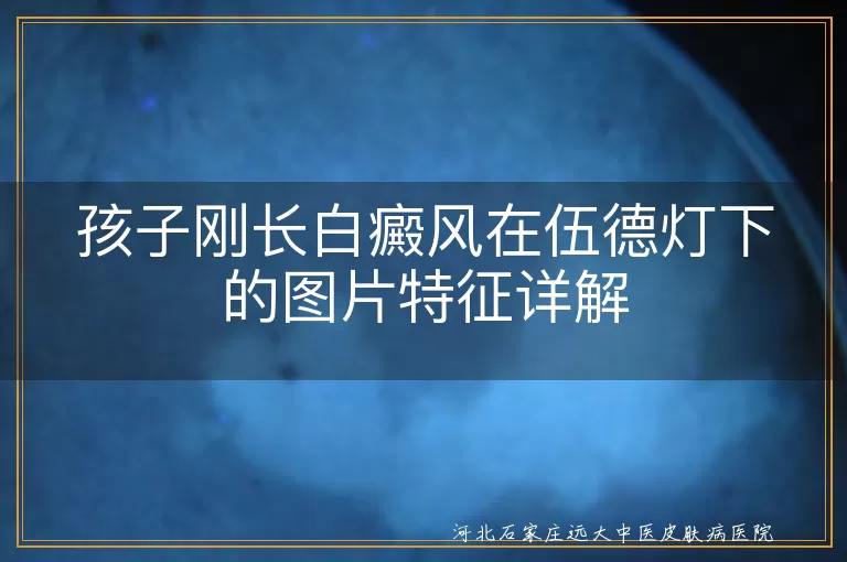 孩子刚长白癜风在伍德灯下的图片特征详解