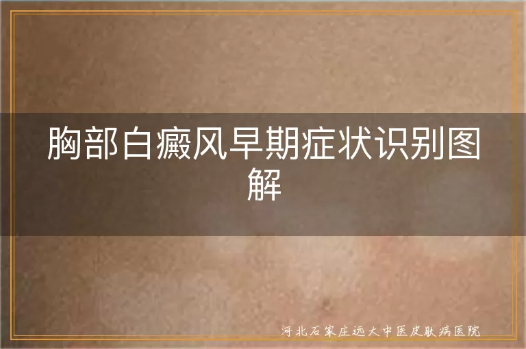 胸部白癜风早期症状识别图解