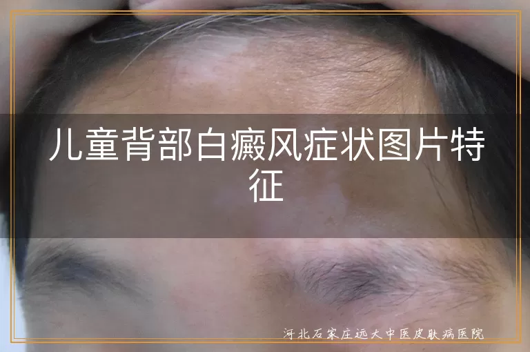 儿童后背白癜风症状图片,小孩背部白斑特征表现,幼儿后背白癜风初期症状