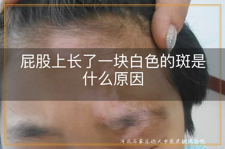 屁股上长了一块白色的斑是什么原因