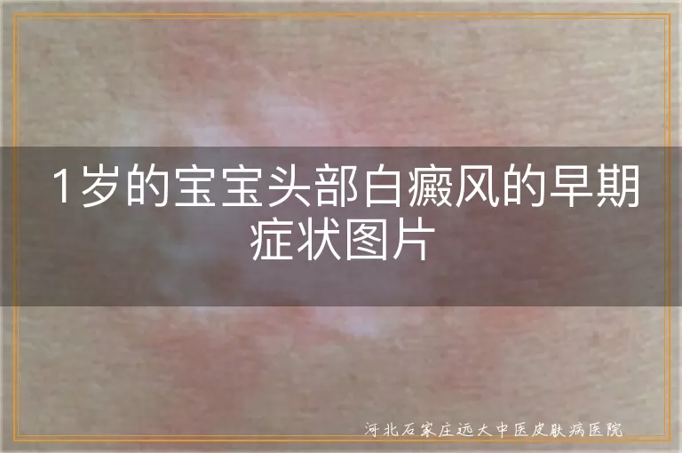 婴儿头部白癜风早期症状图,一岁宝宝头皮白斑照片,婴幼儿头部长白癜风初期表现