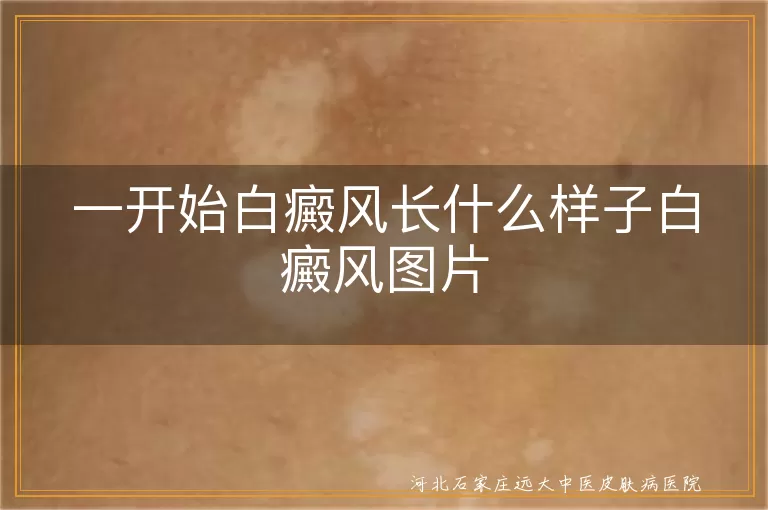白癜风刚开始长什么样图片,初期白斑症状是什么样子,早期白癜风皮肤图片特征