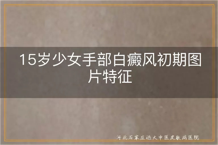 15岁少女手部白癜风初期图片, 青春期女孩手上白斑早期症状, 少女手部白癜风早期表现特征