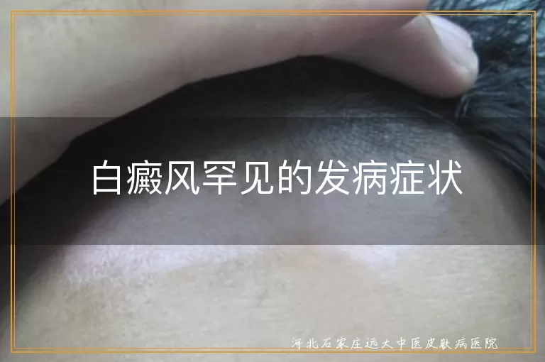 白癜风罕见的发病症状