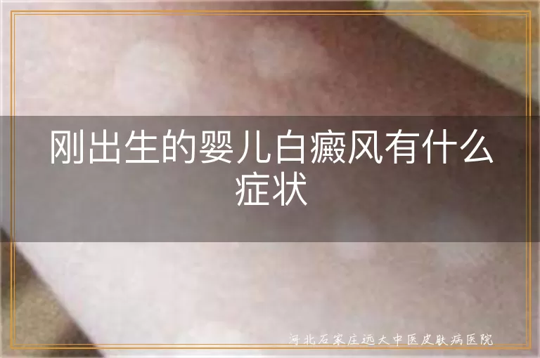 刚出生的婴儿白癜风有什么症状