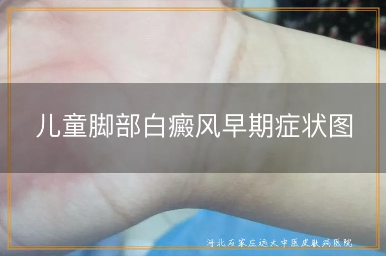 儿童脚部白癜风早期症状表现,孩子脚底白斑初期症状图,小孩足部白癜风早期症状识别