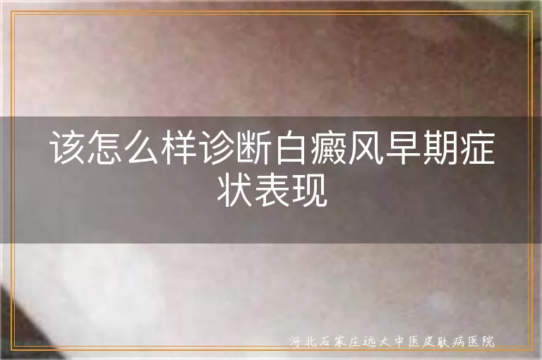 白癜风早期症状怎么识别诊断,白斑初期如何判断是不是白癜风,白癜风早期表现该怎样确诊