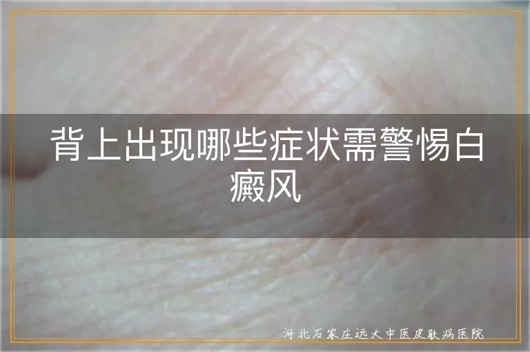 背部白斑症状警惕是白癜风,后背出现白斑是不是白癜风,背上哪些症状可能是白癜风