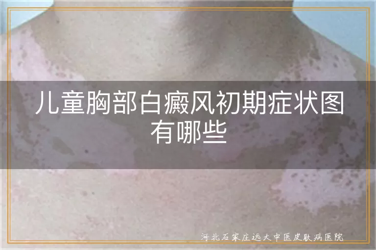 儿童胸部白癜风初期症状图有哪些
