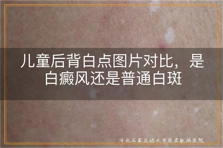 儿童后背白斑图片是不是白癜风,小孩背部白点症状图片参考,幼儿后背白癜风白斑图对比