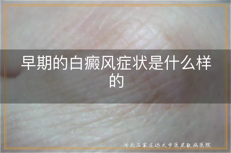 早期的白癜风症状是什么样的