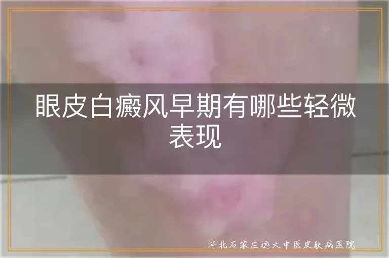 眼皮白癜风早期有哪些轻微表现