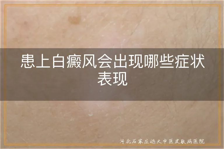 患上白癜风会出现哪些症状表现