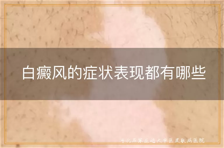 白癜风的症状表现有哪些,白斑常见症状表现是什么,白癜风初期症状有哪些