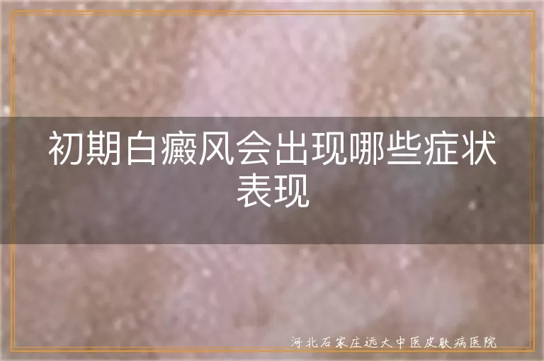初期白癜风会出现哪些症状表现