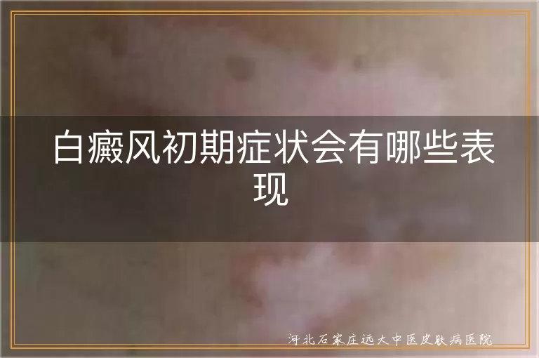 白癜风初期症状有哪些,白斑初期是什么样子,白癜风早期表现会痒吗