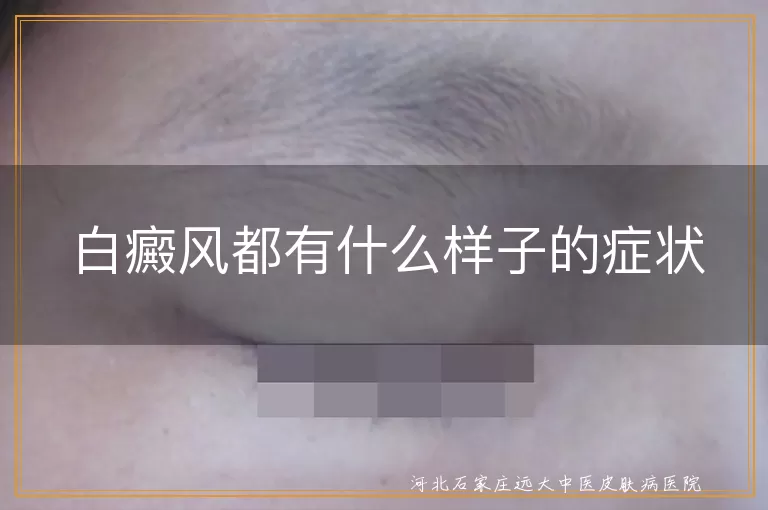白癜风症状早期图片样子,白斑初期有哪些具体表现,白癜风白斑是什么样子的