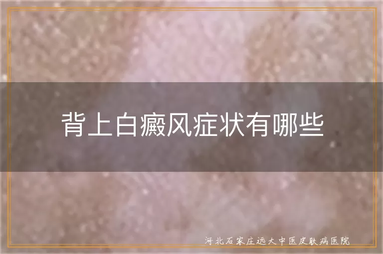 背上长白斑是白癜风的症状吗,背部白癜风早期症状什么样,背上出现白斑要警惕白癜风