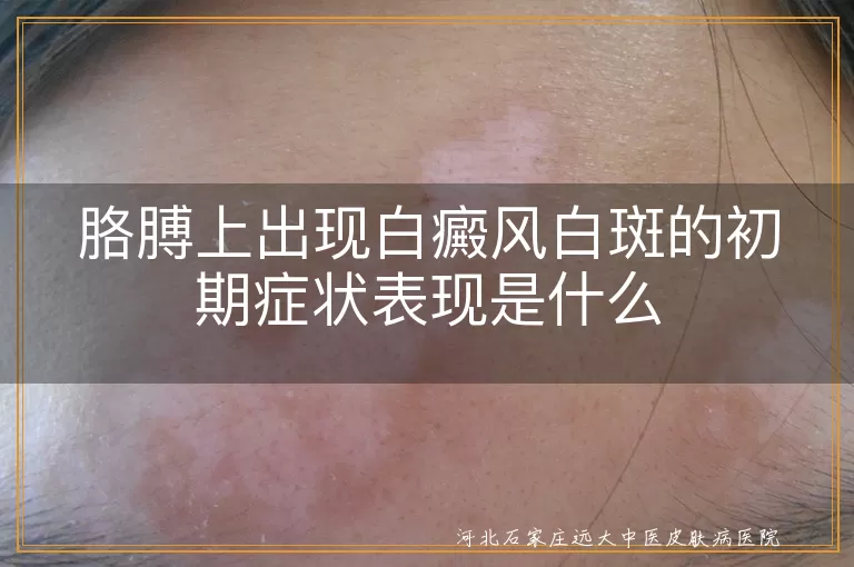 胳膊上出现白癜风白斑的初期症状表现是什么