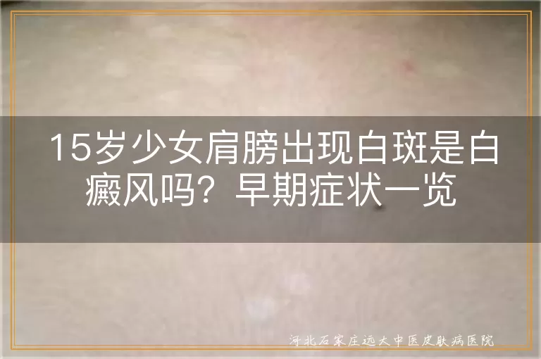 少女肩膀白斑早期症状,15岁肩膀白斑是白癜风吗,青少年肩膀白癜风迹象