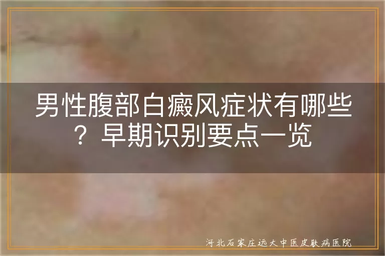 男性腹部白斑是白癜风吗,肚子白癜风早期症状图片,男性腹部白癜风怎么判断