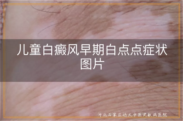 儿童白癜风早期白斑图片症状,小孩身上白点点是白癜风图片吗,儿童白斑早期症状图片白癜风