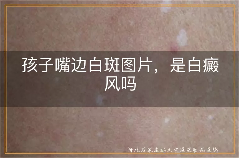 孩子嘴边白斑图片，是白癜风吗