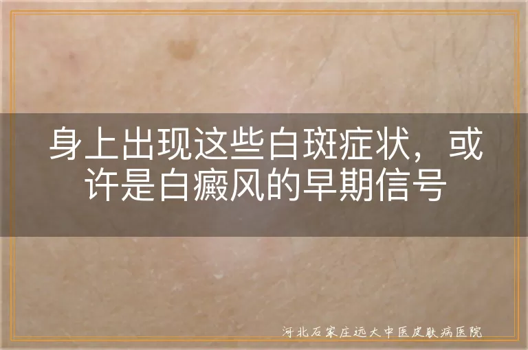 皮肤长白斑怎么判断是白癜风,身上白斑有这几种表现要警惕,白斑不痛不痒边界清晰可能是白癜风