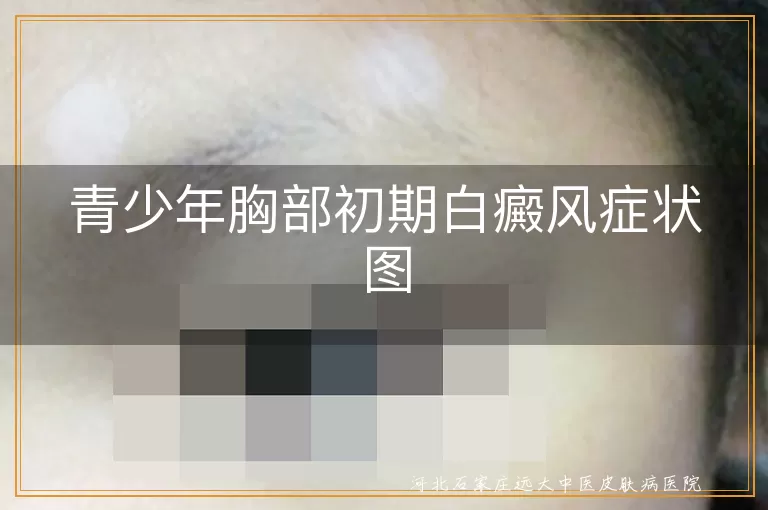 青少年胸部白斑初期症状,青少年早期胸部白癜风症状图,胸部白癜风初期有哪些表现