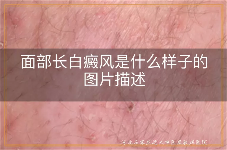 面部白癜风症状图片什么样,脸上长白斑图片特点,面部白斑白癜风的图片表现