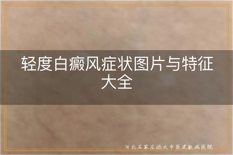 轻度白癜风症状图片与特征大全