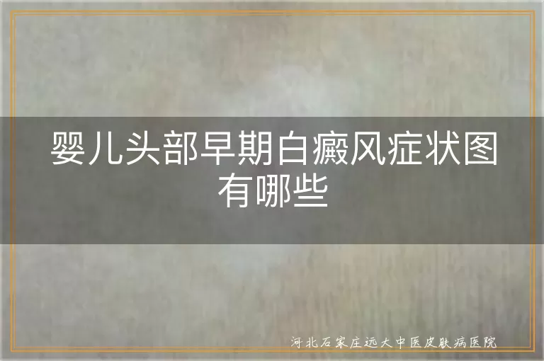 婴儿头部早期白癜风症状图有哪些