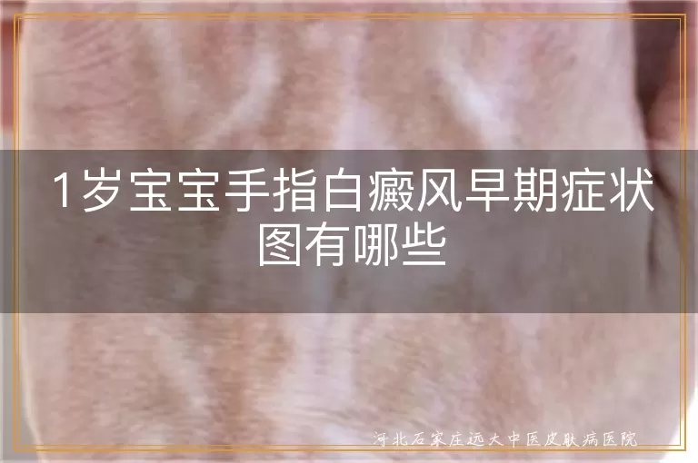 1岁宝宝手指白癜风早期症状图,宝宝手指有白斑是白癜风初期图,婴幼儿手指白癜风早期图片症状