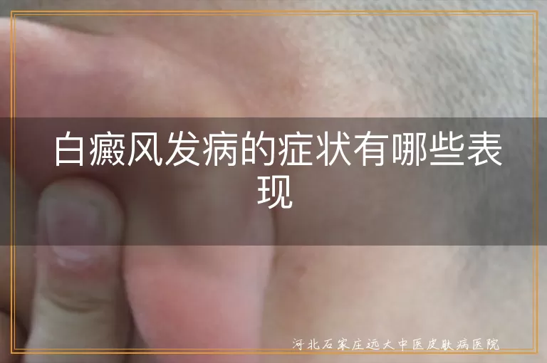 白癜风初期白斑长什么样,白斑哪些症状属于白癜风,白癜风的早期发病表现有哪些