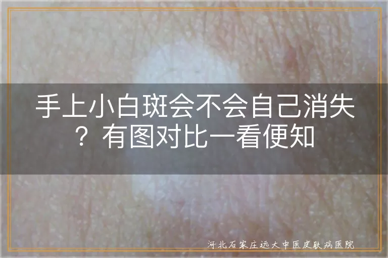 手上白斑会自己消失吗白癜风图片,手上小白斑自行消退可能情况,白癜风白斑图片能否不治而愈